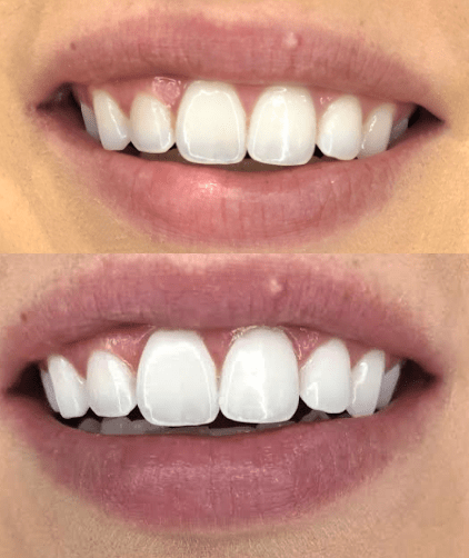 Before and After Teeth Whitening